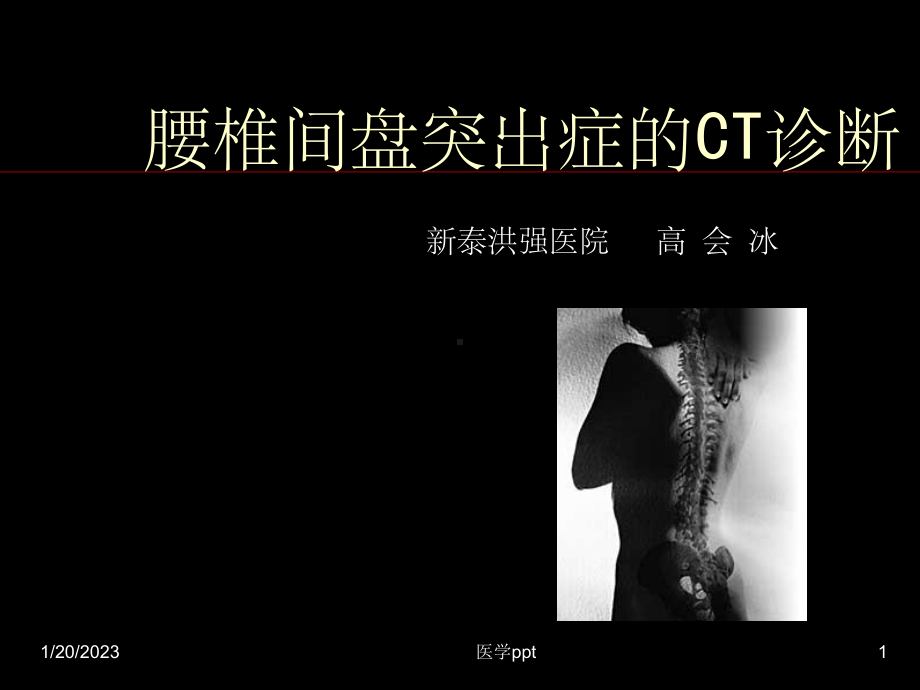 椎间盘突出症的CT表现高会冰课件.ppt_第1页