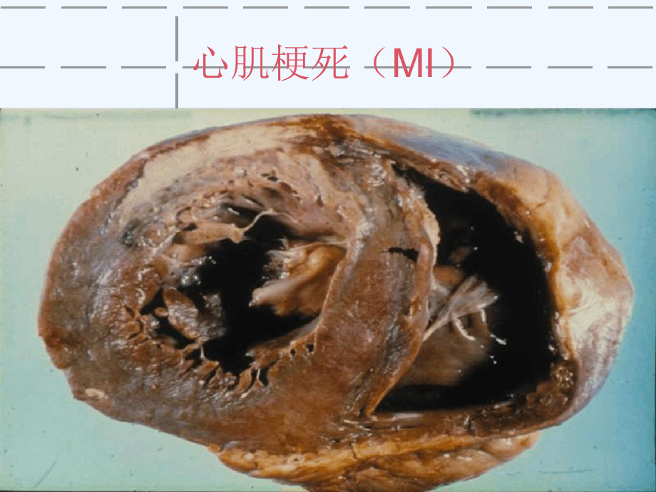 急性心肌梗死诊断及治疗进展课件.ppt_第1页