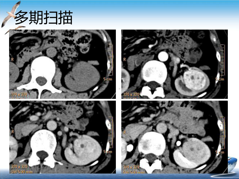 教学读片肾脏富血供肿瘤CT诊断课件.pptx_第3页