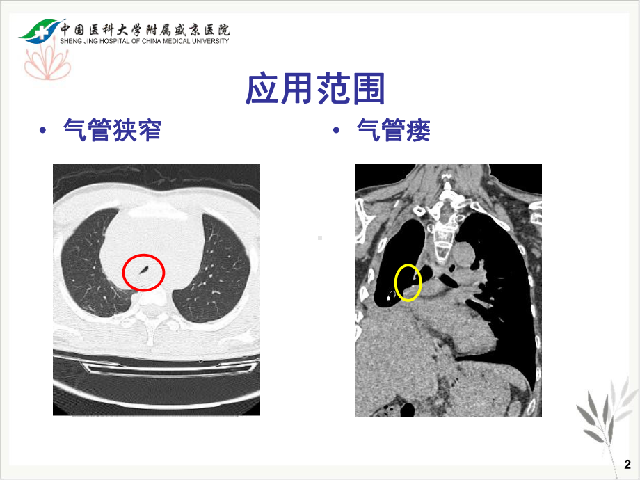 气管支架临床应用课件.pptx_第2页