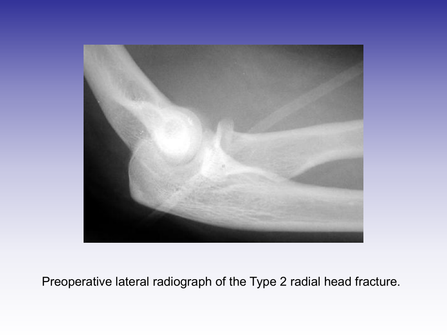 桡骨小头骨折切开内固定课件整理.ppt_第3页