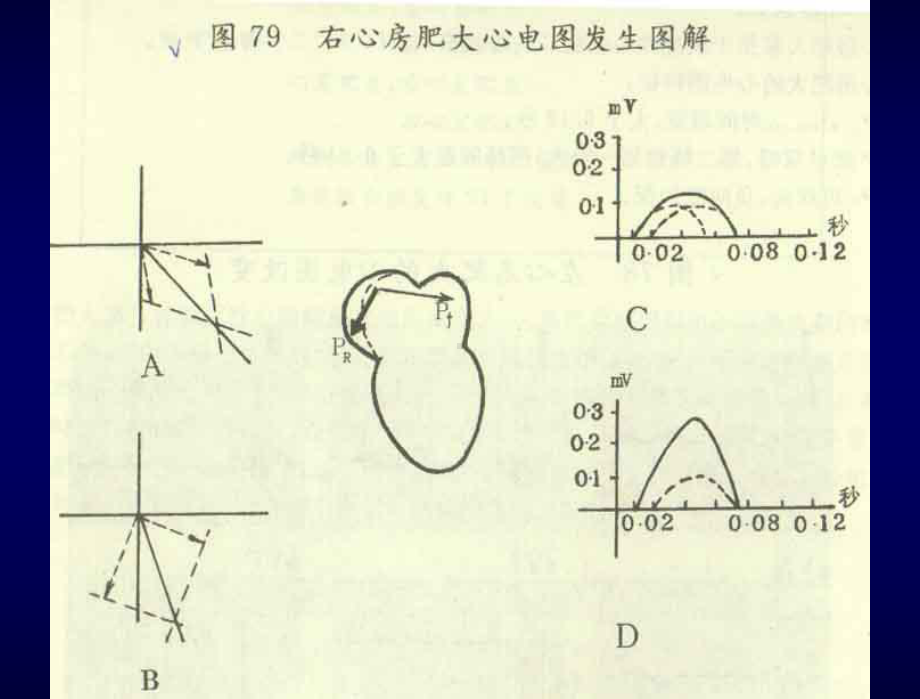 心房-心室肥大心电图诊断课件.ppt_第2页