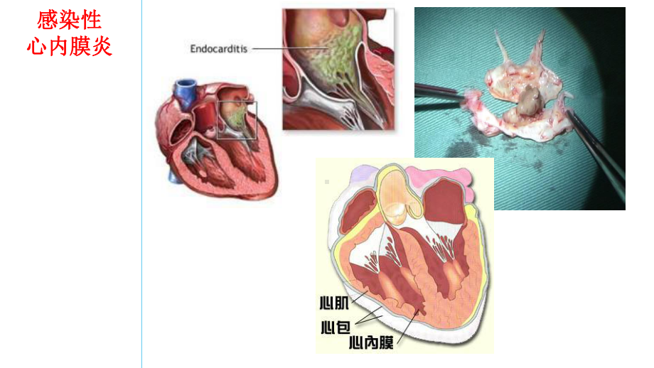 感染性心内膜炎要点及习题讲解课件.ppt_第3页