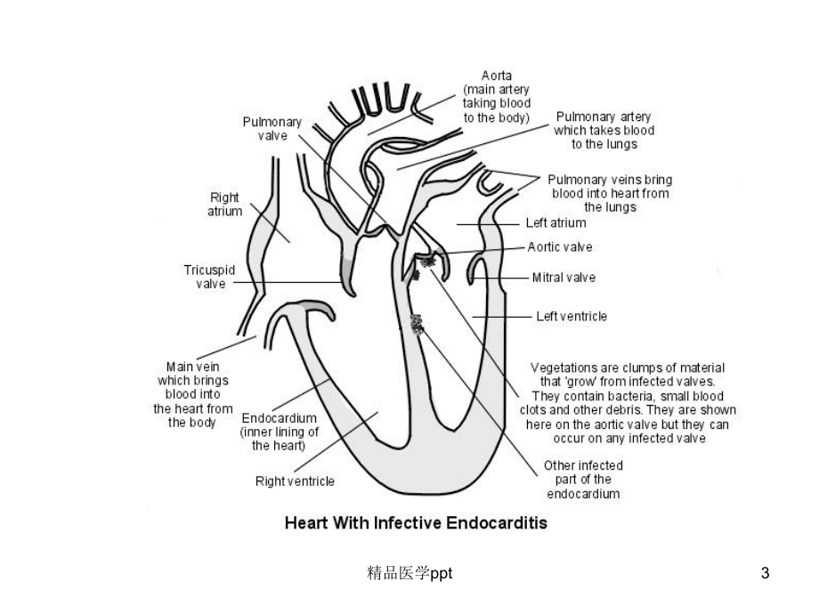 感染性心内膜炎课件1.ppt_第3页