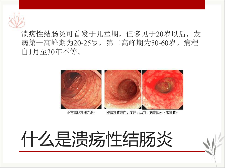 溃疡性结肠炎的治疗课件.pptx_第2页