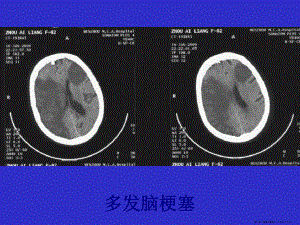 常见疾病典型CT片课件.ppt