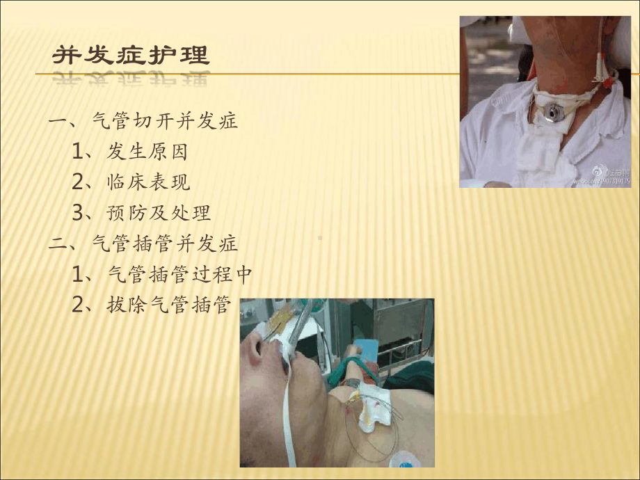 气管切开与气管插管护理课件.ppt_第2页