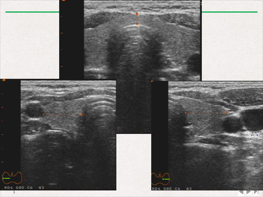 甲状腺病变的超声诊断讲课资料标准课件.ppt_第3页