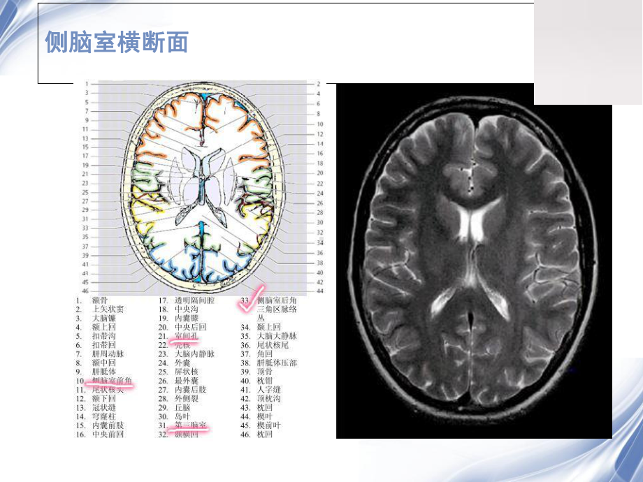 室管膜瘤课件.ppt_第3页