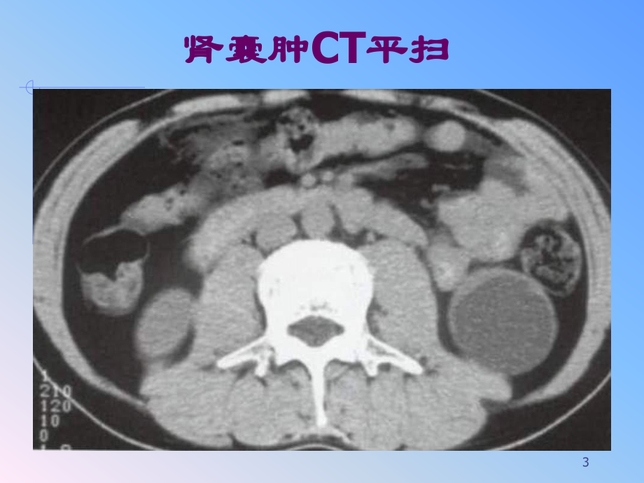 泌尿系统影像诊断课件.pptx_第3页