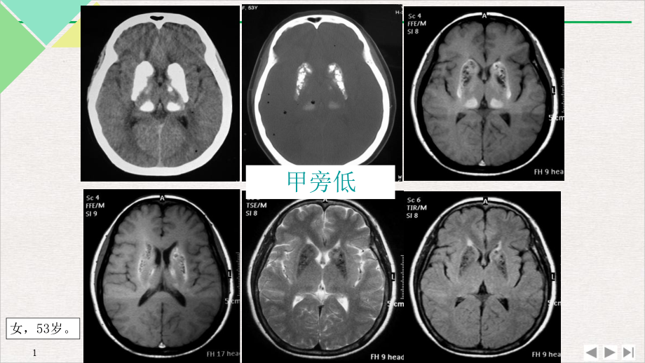 甲状旁腺功能减退症实用版课件.pptx_第1页