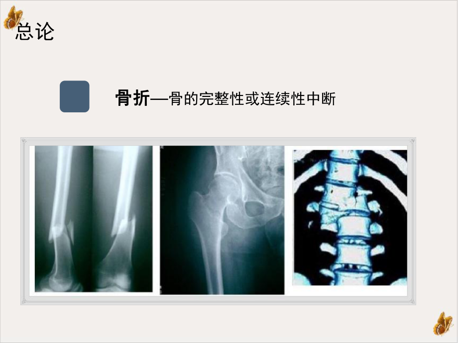 机动库骨折的固定及搬运培训课件.ppt_第3页