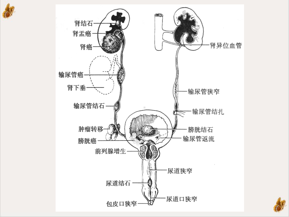 泌尿系统梗阻疾病病人的护理培训课件.pptx_第1页