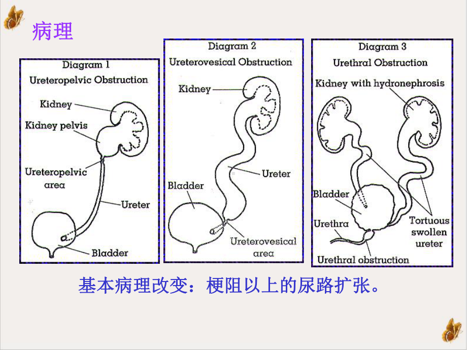 泌尿系统梗阻疾病病人的护理培训课件.pptx_第2页