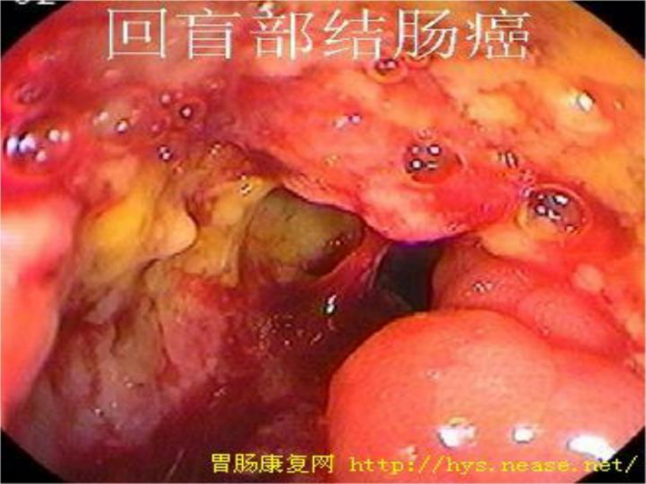 最新课件结肠癌结肠癌.ppt_第3页