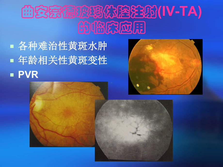 治疗CRVO的新看法TA在玻璃体切割术中的辅助应用双手法操作技术课件.ppt_第3页