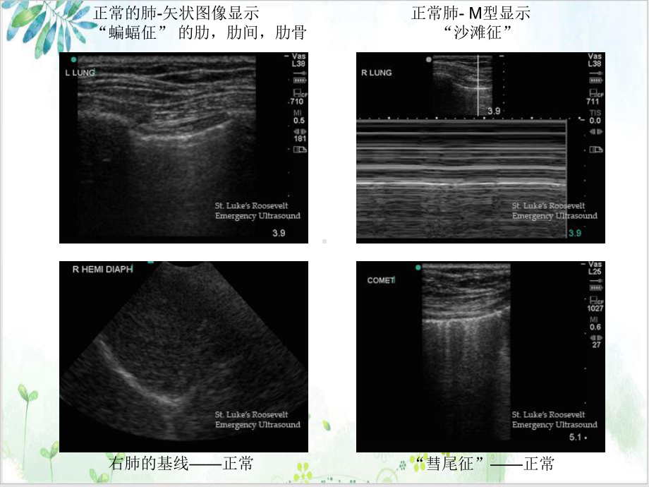 急性呼吸衰竭的肺部超声诊断中文课件.ppt_第3页