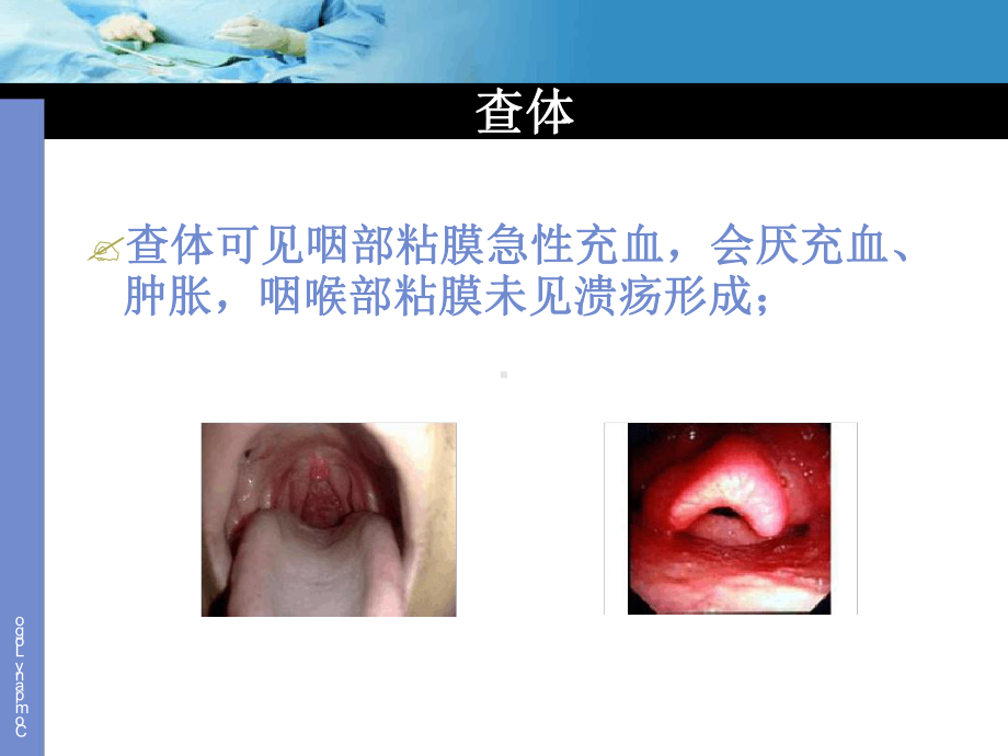 治不好的急性会厌炎课件.ppt_第3页