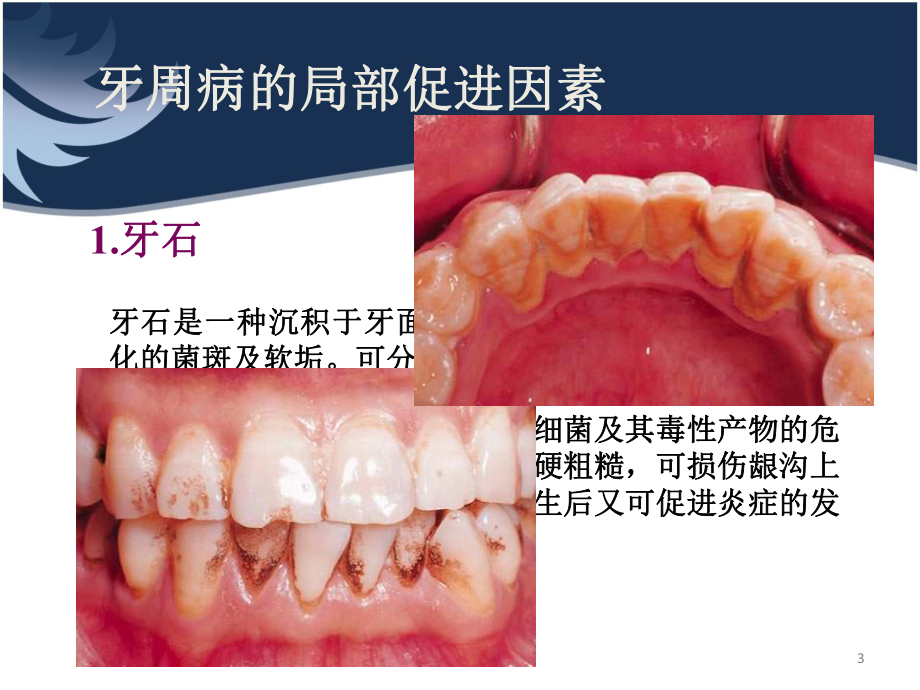 牙周病的局部及全身促进因素课件.ppt_第3页