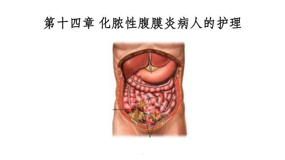 急性化脓性腹膜炎病人的护理课件整理.ppt_第1页