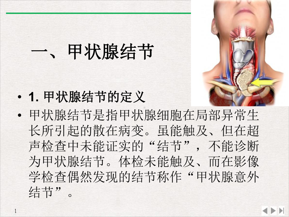 甲状腺结节诊治和手术治疗课件.ppt_第2页