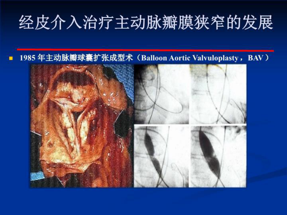 最新经导管主动脉瓣置换术课件.ppt_第3页