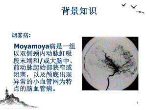 烟雾病颅内外血管搭桥治疗缺血性脑血管疾病课件.pptx