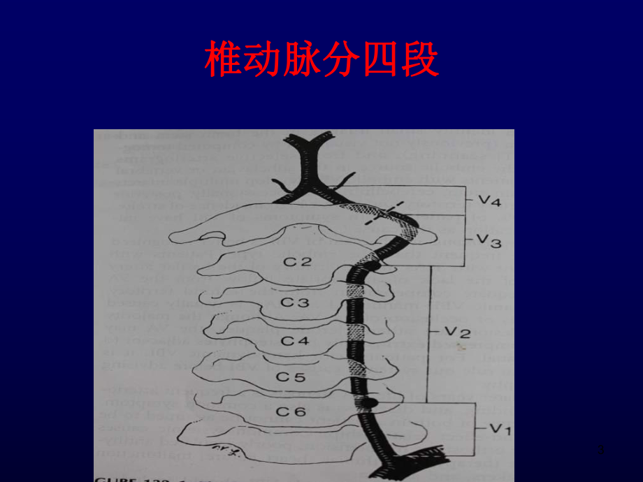 椎动脉病变的手术治疗课件.ppt_第3页