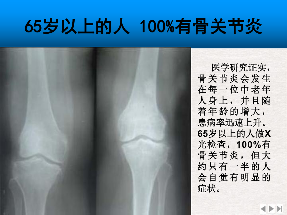 氨糖与骨关节病专家会销课件.ppt_第3页