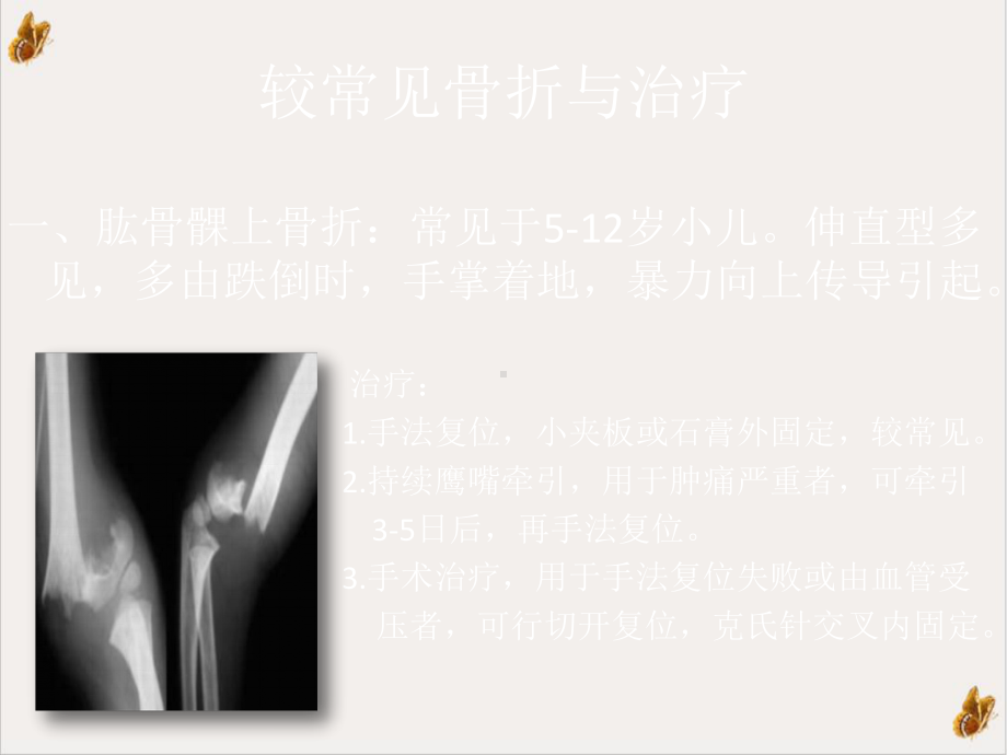 浅谈骨折与其再生课件.pptx_第2页