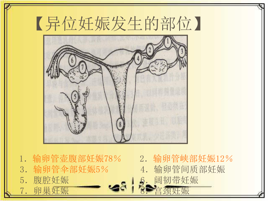 异位妊娠的护理1课件.ppt_第3页