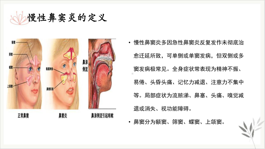 慢性鼻窦炎护理查房课件.pptx_第2页