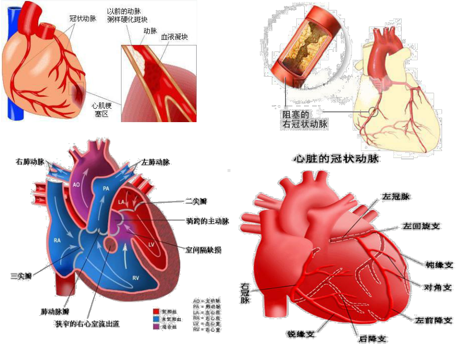 心肌梗死患者的护理-课件.pptx_第3页