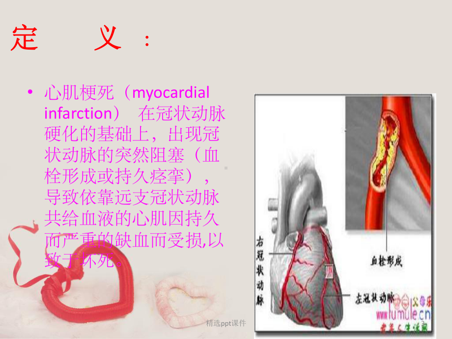 急性心肌梗死的查房护理课件.pptx_第3页