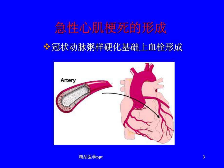 急性心肌梗死的心电图讲课件.ppt_第3页