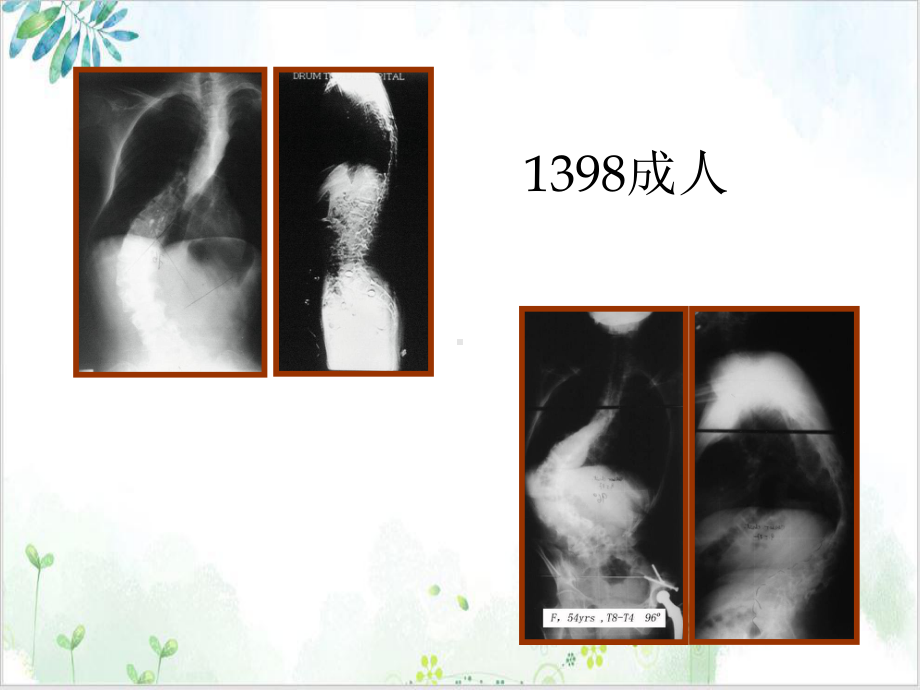 成人脊柱侧凸的的治疗课件整理.ppt_第3页