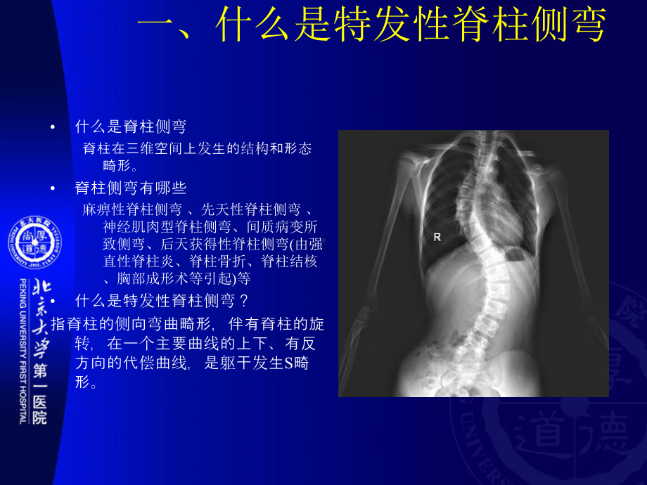 特发性脊柱侧弯的防治August25课件.ppt_第3页