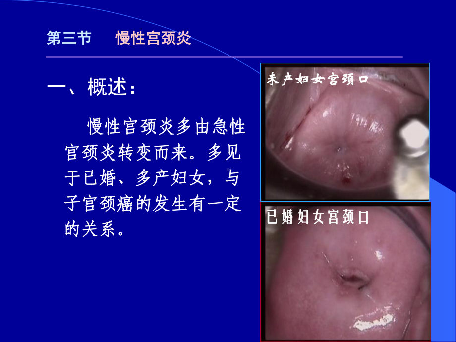 慢性宫颈炎的病理课件.ppt_第3页