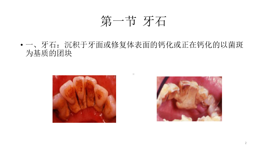 牙周病发病的促进因素课件.ppt_第2页