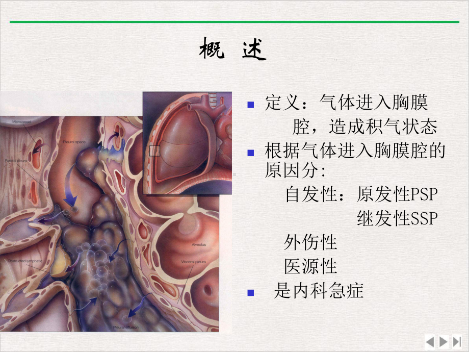 气胸内科学课件.ppt_第2页