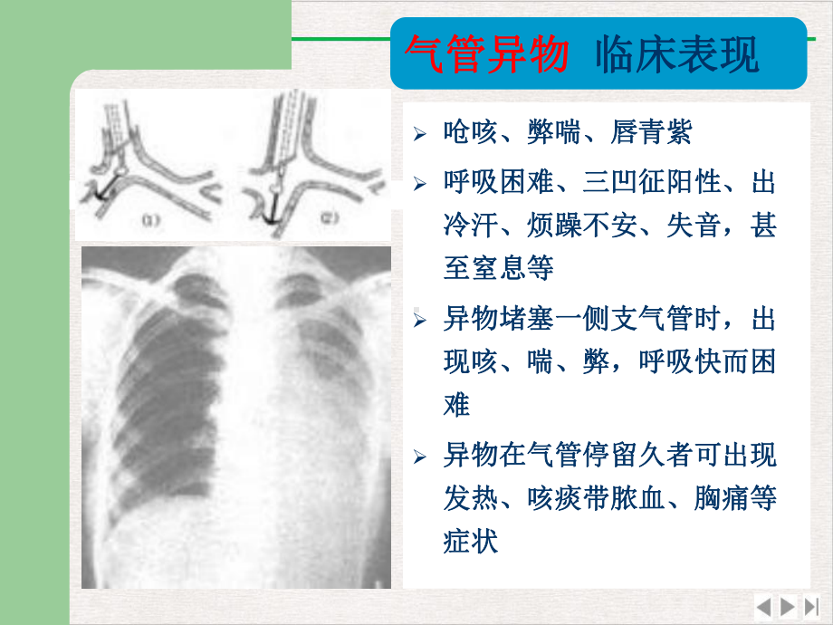 气管异物急救课件.pptx_第3页