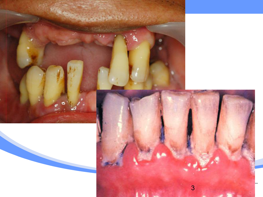 牙周病的诊断课件.pptx_第3页