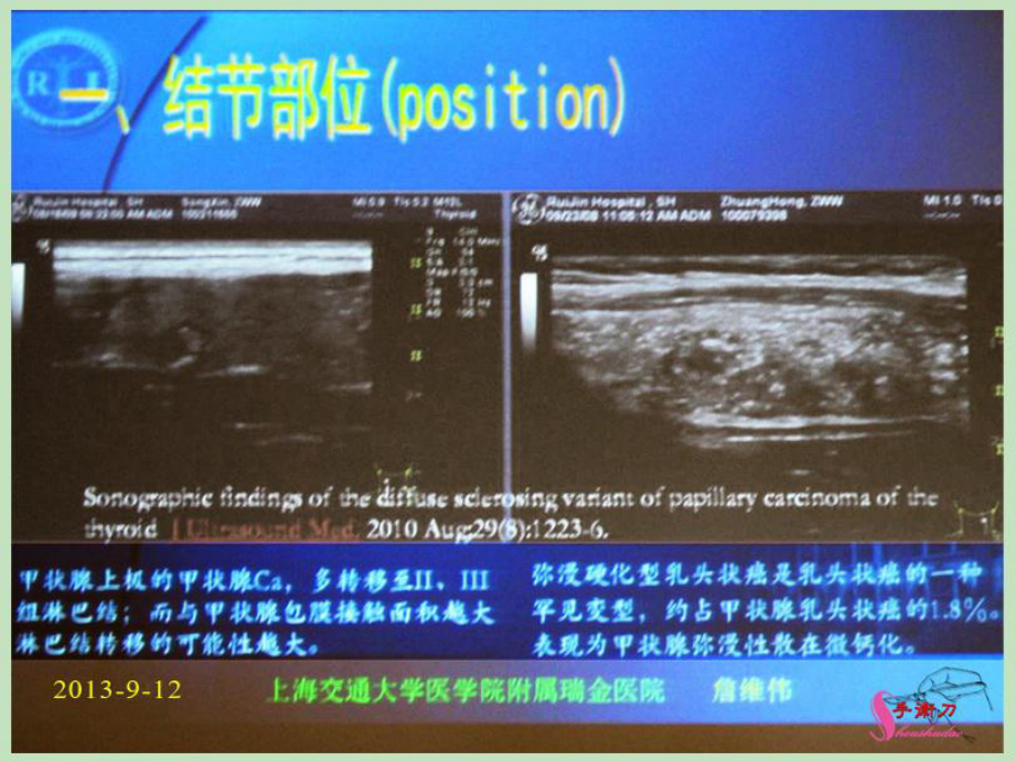 甲状腺结节超声规范及其进展课件.pptx_第2页