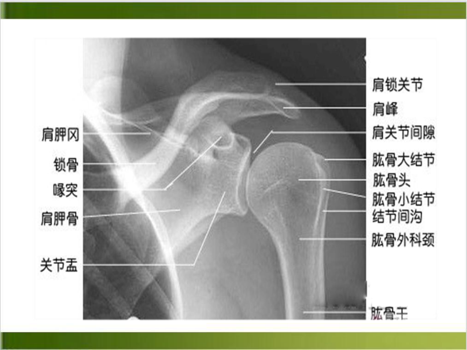 肩关节置换手术相关解剖及手术护理培训课件.ppt_第3页