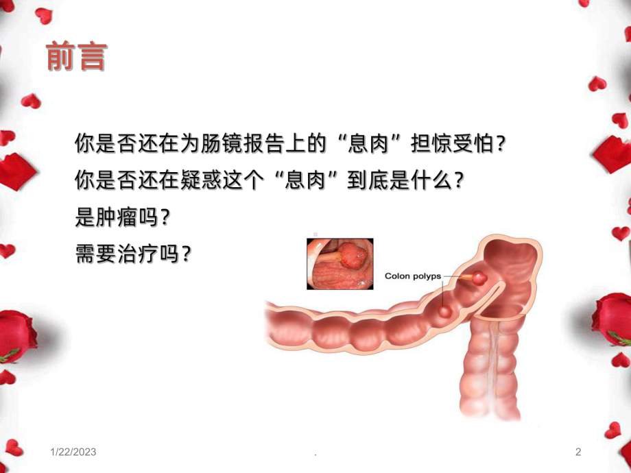 知悉肠息肉课件.ppt_第2页