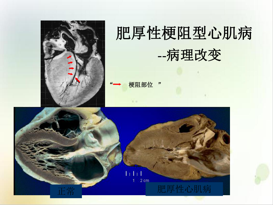 肥厚性心肌病经皮腔内室间隔心肌消融术课件.ppt_第3页