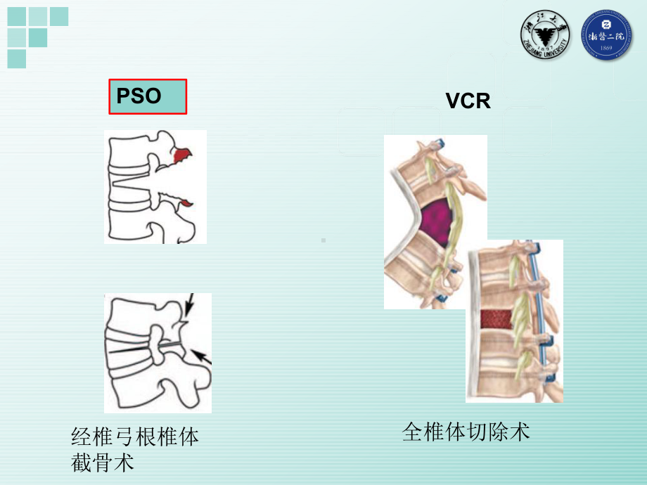 脊柱截骨矫形手术安全保障讲义课件.ppt_第3页