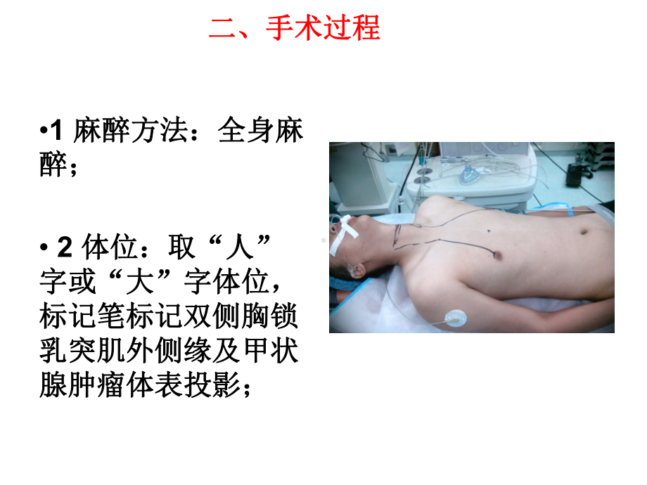 腹腔镜甲状腺切除手术体会课件.ppt_第3页