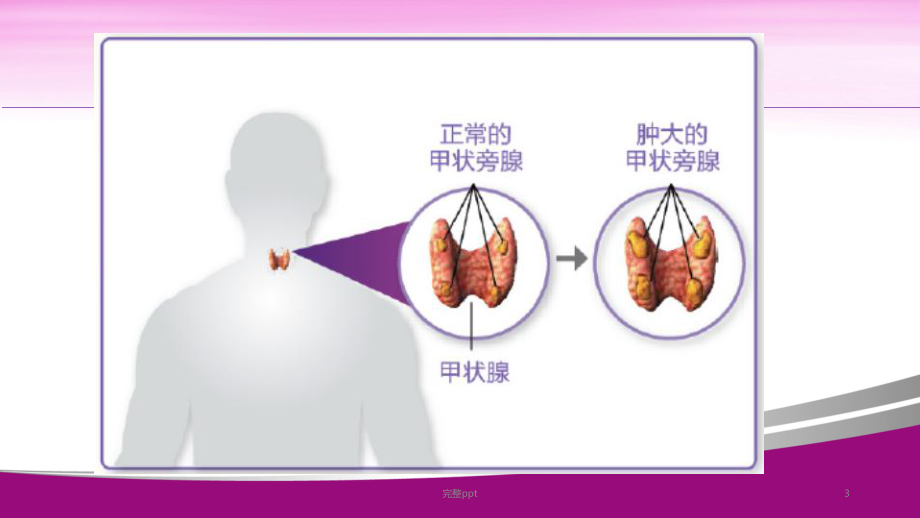 认识继发性甲旁亢课件.ppt_第3页