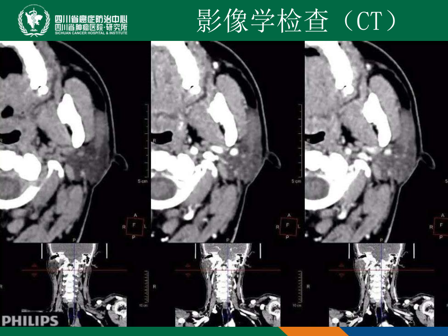 神经鞘瘤病例讨论一例课件.ppt_第2页